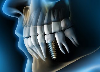 10 important facts about dental implants dental-implants-in-lalitpur