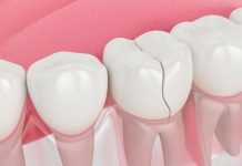 Why is it important to get your chipped or cracked tooth fixed? Best Dental Treatment in Lalitpur