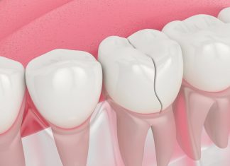 Why is it important to get your chipped or cracked tooth fixed? Best Dental Treatment in Lalitpur