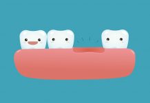 Why replacing lost tooth is important? Lost-Tooth