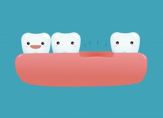 Why replacing lost tooth is important? Lost-Tooth